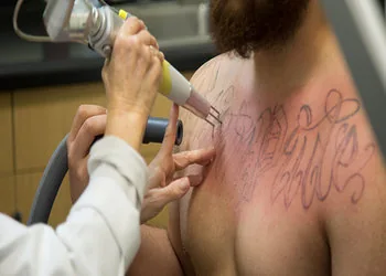 Tattoo removal at Vanish Laser Aesthetics